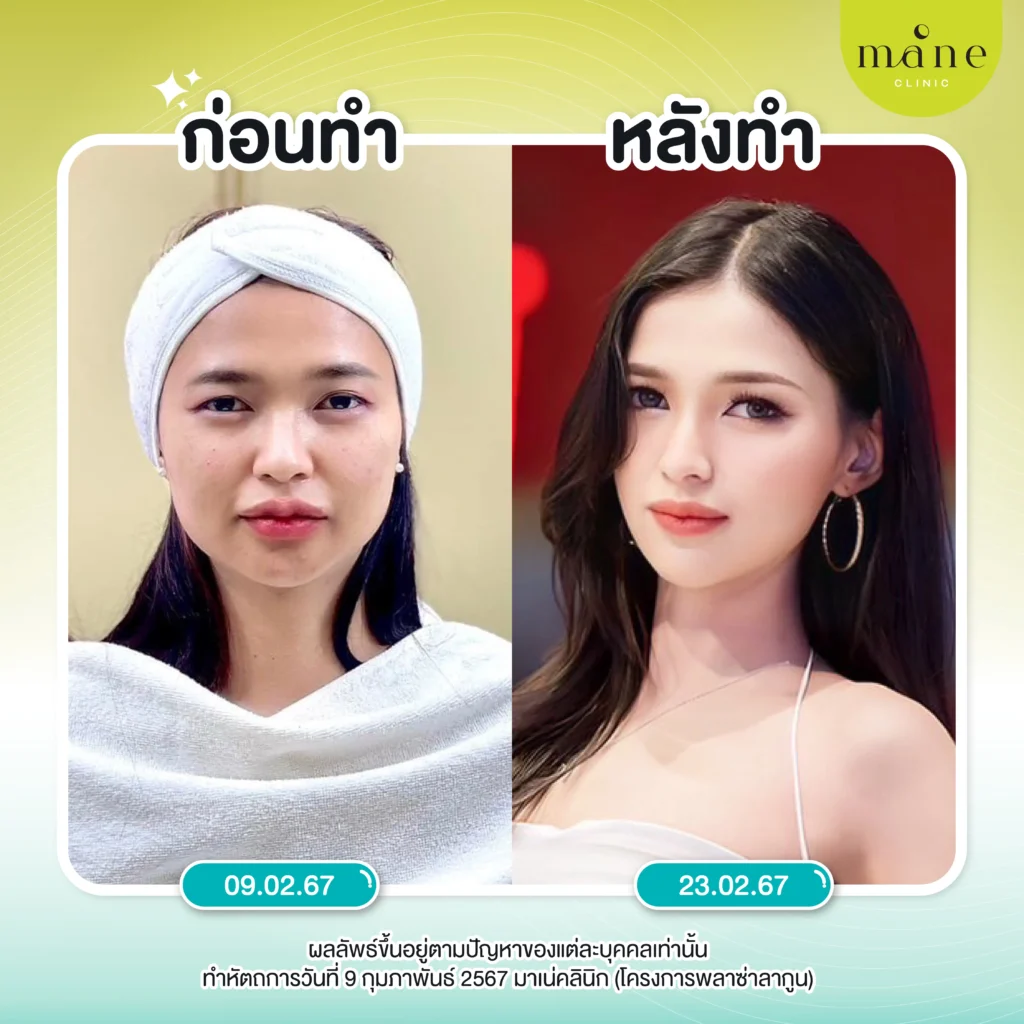 รีวิว plasma แก้ฝ้า โดย K. โมนา