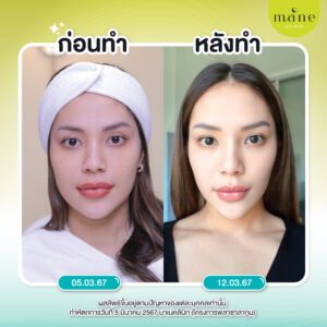 รีวิว plasma แก้ฝ้า ที่ mane clinic