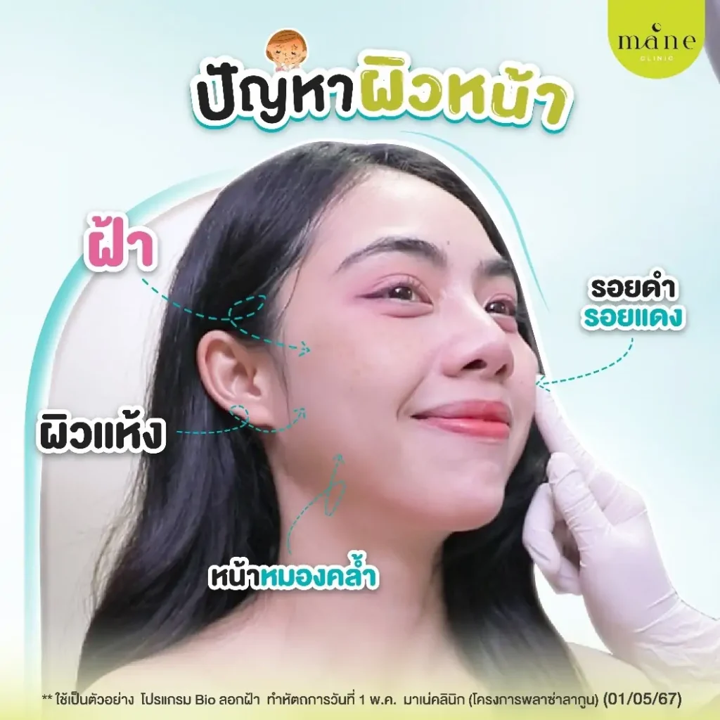 ปัญหาผิวหน้า bio ลอกฝ้า