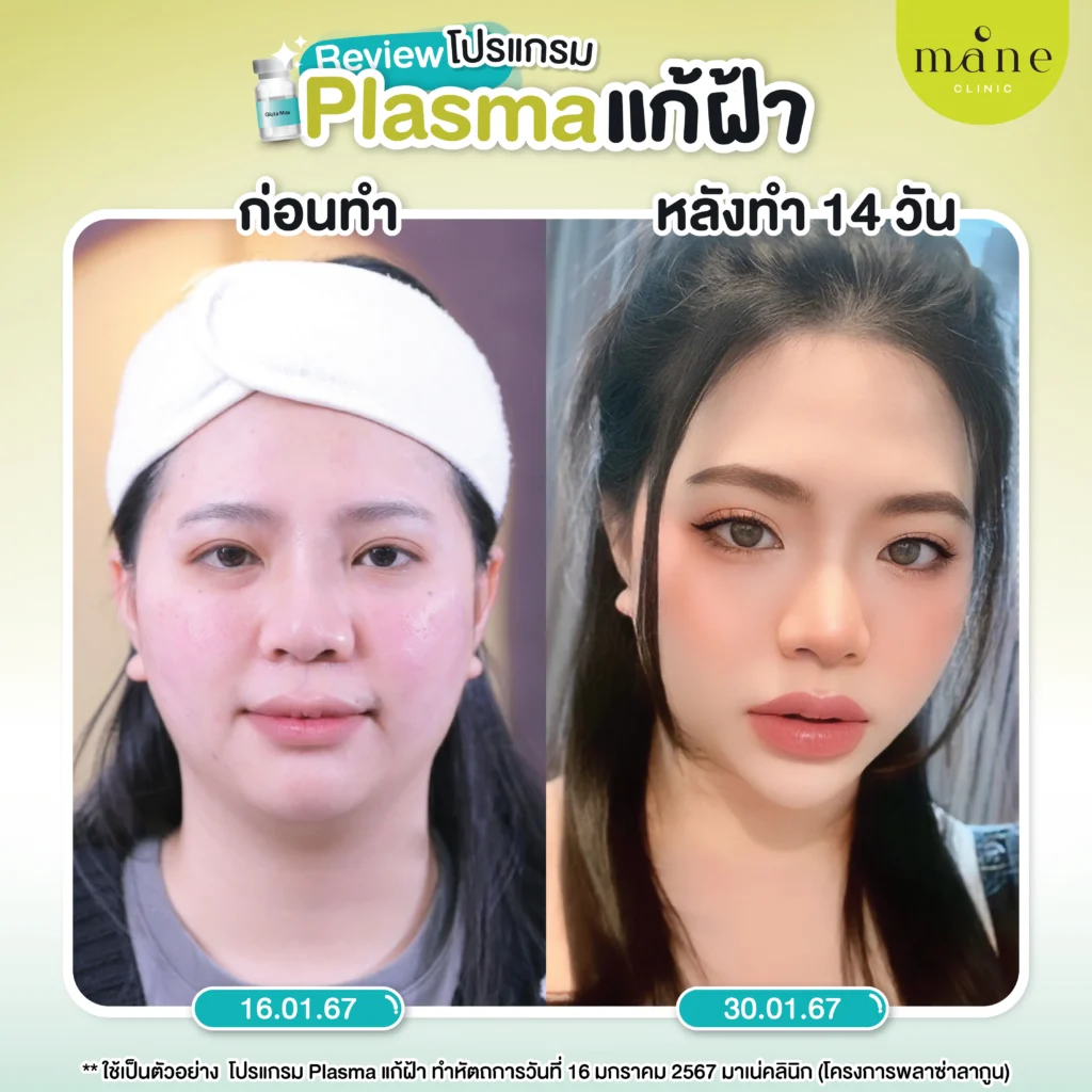 รีวิว plasma แก้ฝ้า ที่ mane clinic