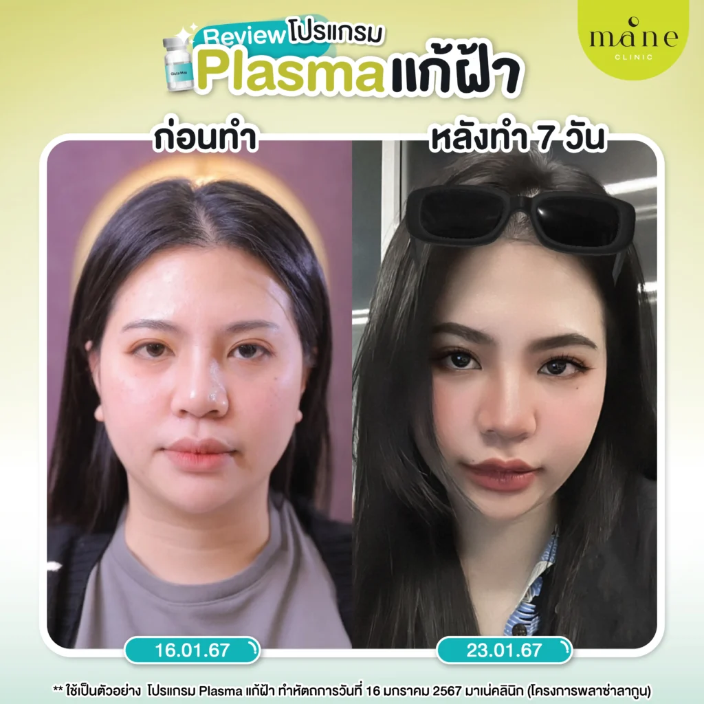 รีวิว plasma แก้ฝ้า ที่ mane clinic