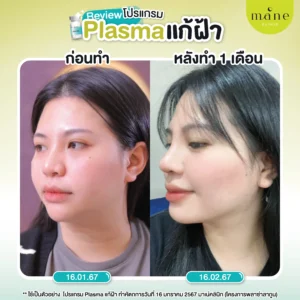 รีวิว plasma แก้ฝ้า ที่ mane clinic