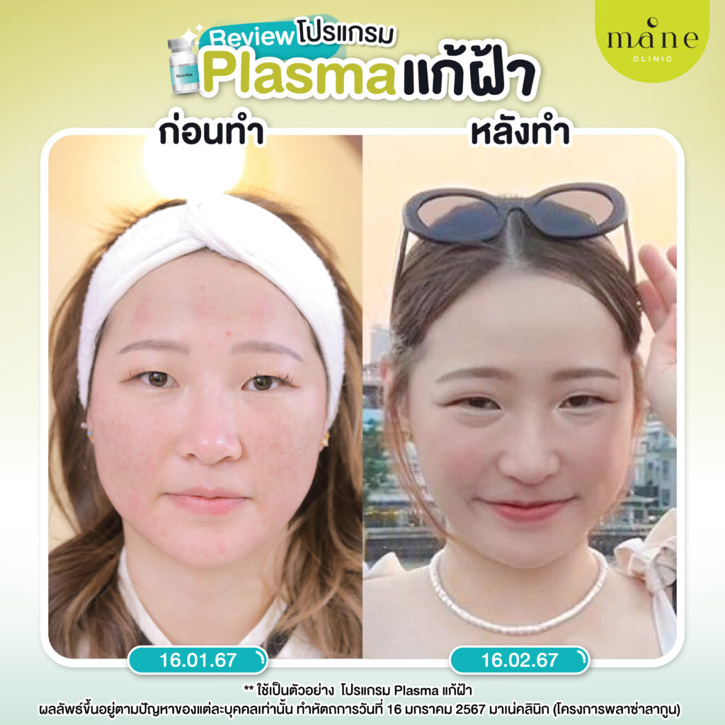 รีวิว plasma แก้ฝ้า ที่ mane clinic