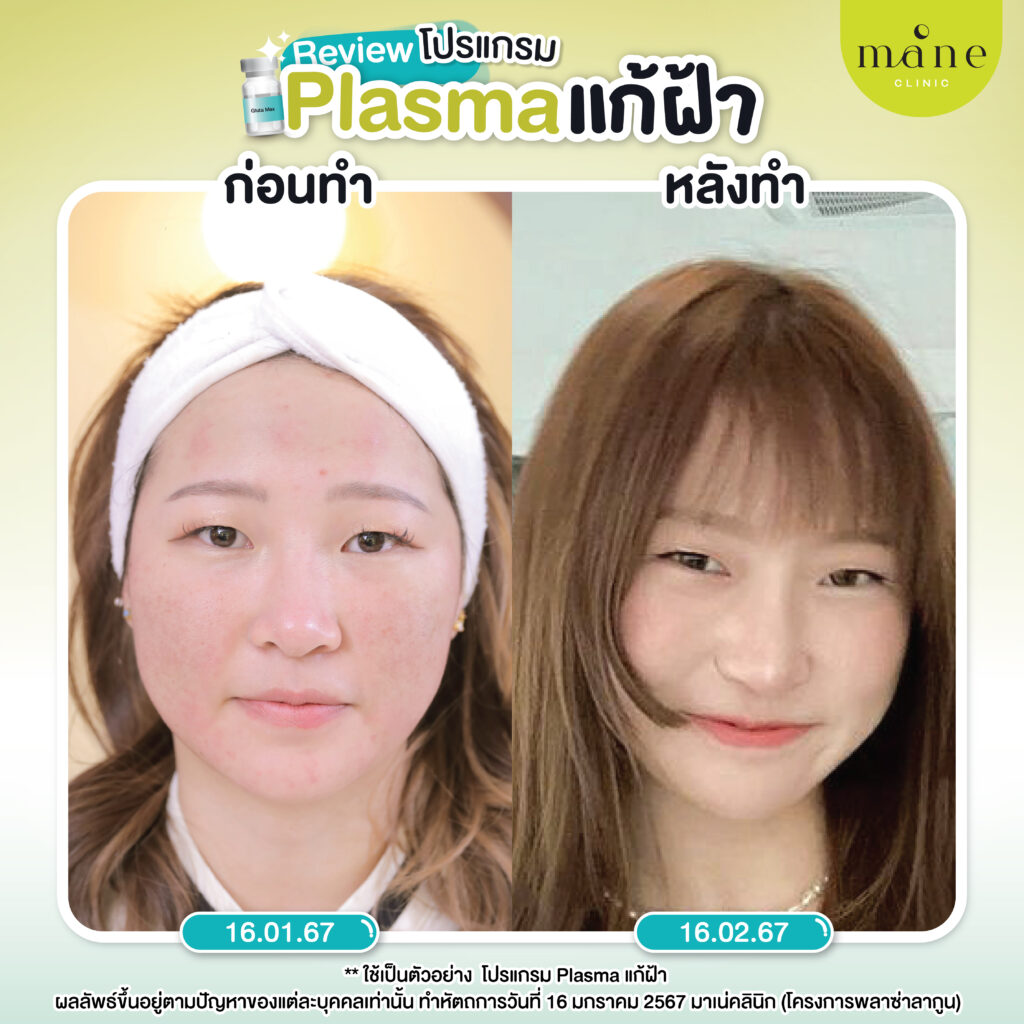 รีวิว plasma แก้ฝ้า ที่ mane clinic