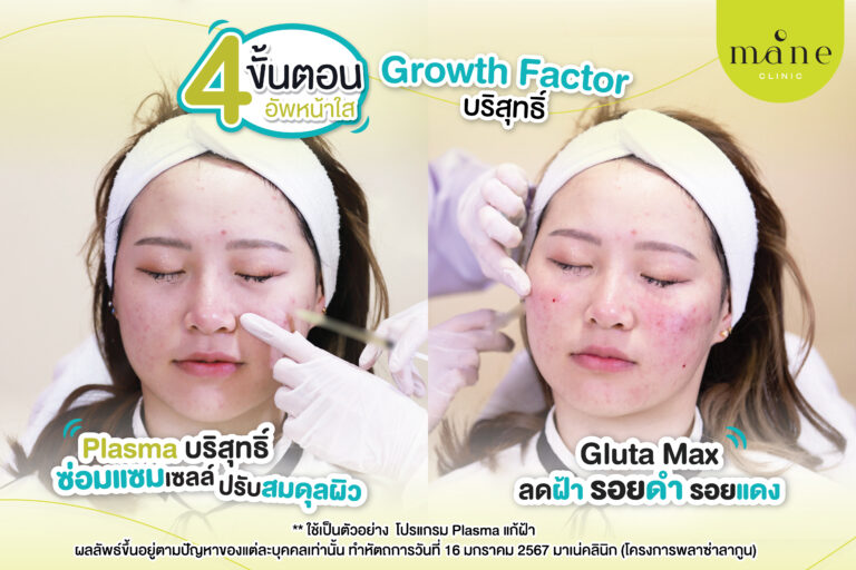 รีวิว plasma แก้ฝ้า ที่ mane clinic